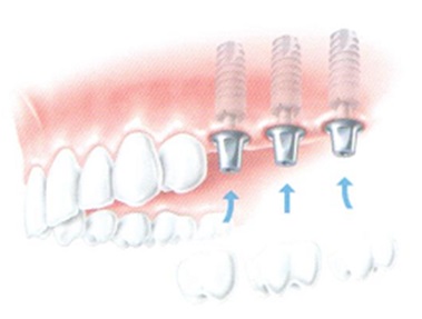 zkrácený zubní oblouk - jednotlivé implantáty