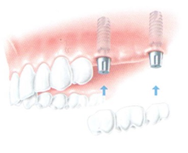 zkrácený zubní oblouk - můstek nesený implantáty