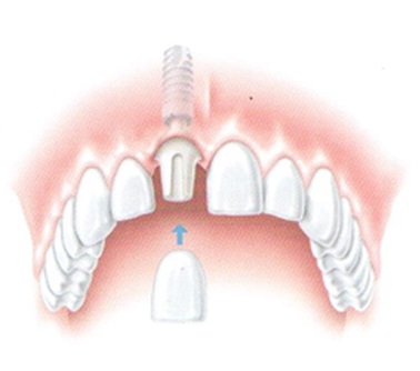 jeden chybějící zub - řešení implantátem