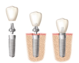 zubní implantát schéma