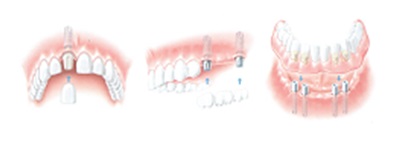 nasazení zubního implantátu