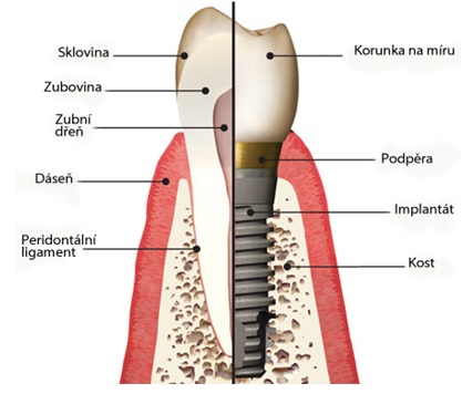 funkce zubního implantátu
